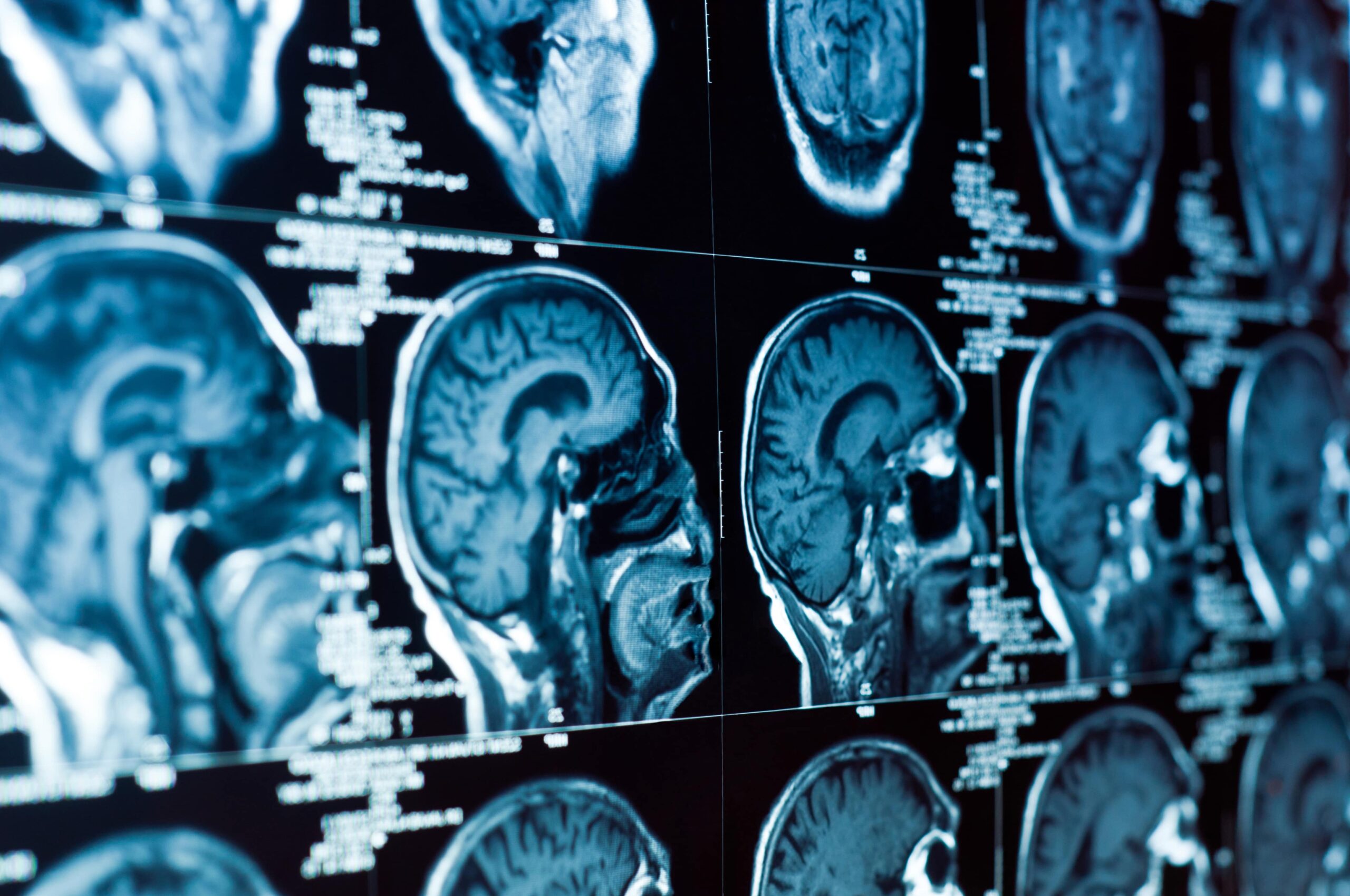 Brain Injury Lawyer Omaha, NE