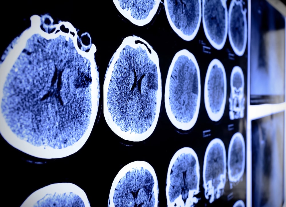 brain injury lawyer Omaha, NE