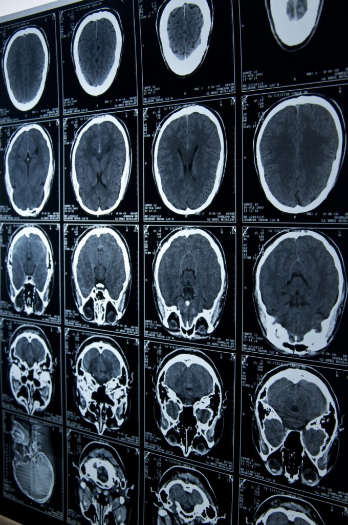 brain injury lawyer Omaha, NE